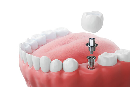 Implant Dentures