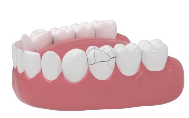 Relines And Reairs Dentures